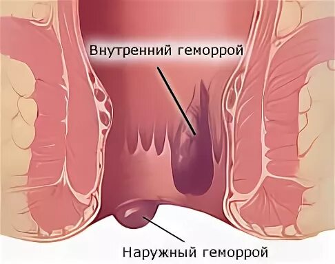 Лечение геморроя в Омске, симптомы и диагностика