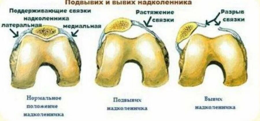 Латерализация надколенника. Повреждение связки надколенника симптомы. Частичное повреждение латерального удерживателя надколенника. Медиальный удерживатель надколенника повреждение. Травма связки надколенника симптомы.