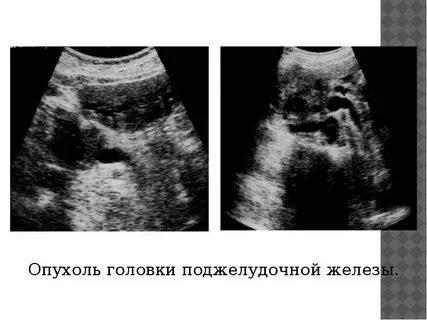Головка поджелудочной железы опухоль лечение