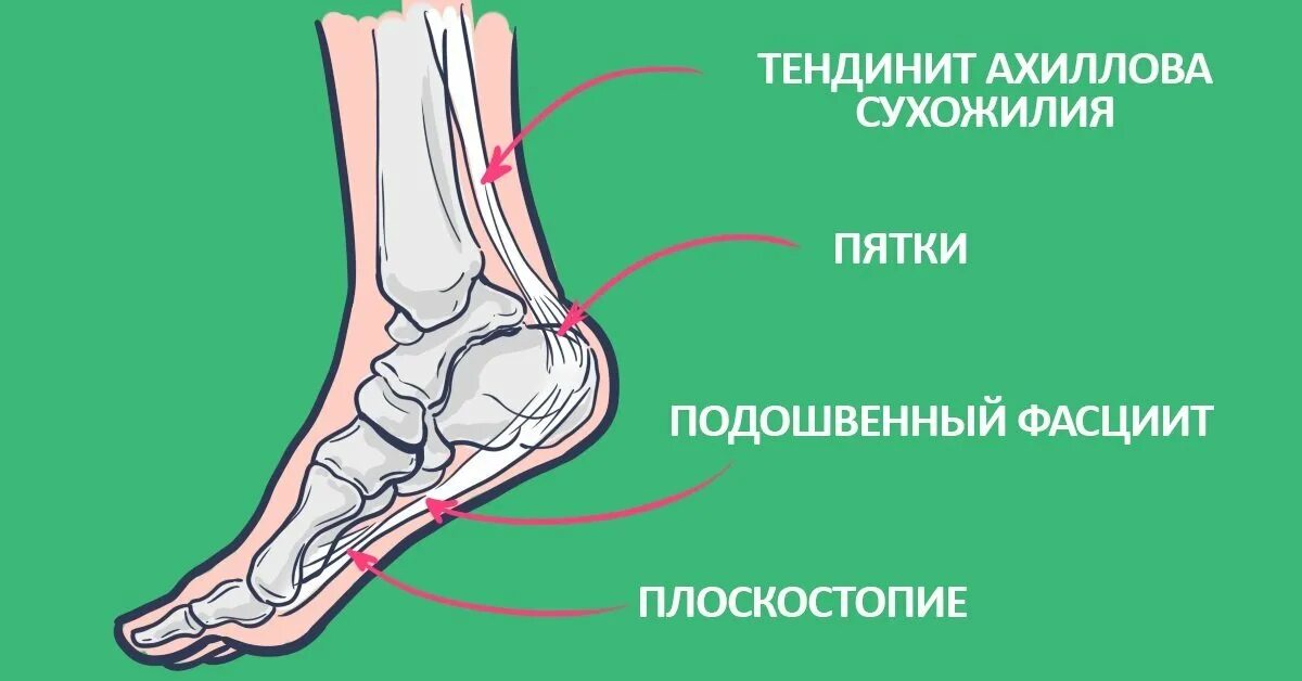 Плоскостопие ахиллова сухожилия. Пяточная ахиллова сухожилия. Ноги гудят и ноют