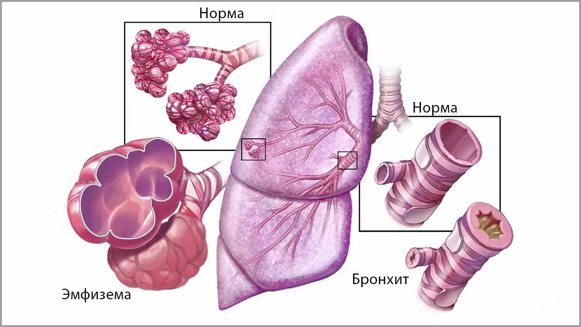 Эмфизема хронического бронхита. Бронхит и эмфизема легких. Эмфизема и хронический бронхит.