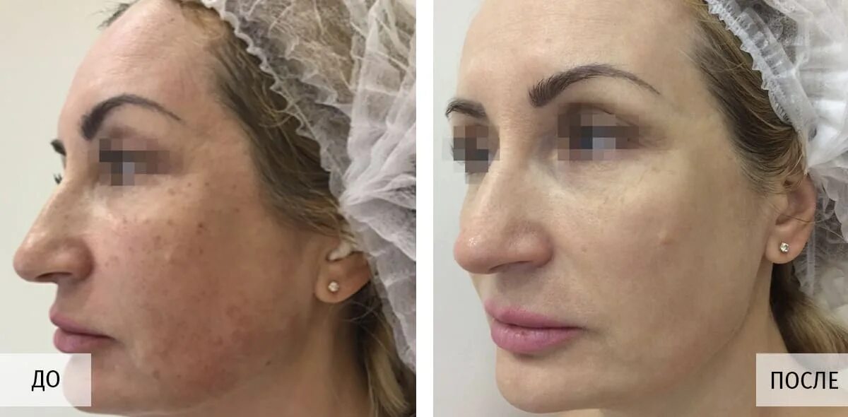Лицо после м22. Фотоомоложение до и после. М22 фотоомоложение эффект. Lumenis m22 лазерная шлифовка. Омоложение м22.