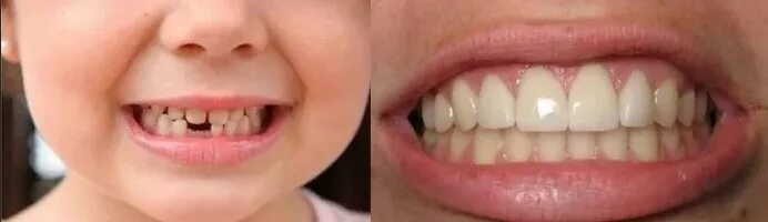 Как отличить молочный зуб. Временные молочные зубы.