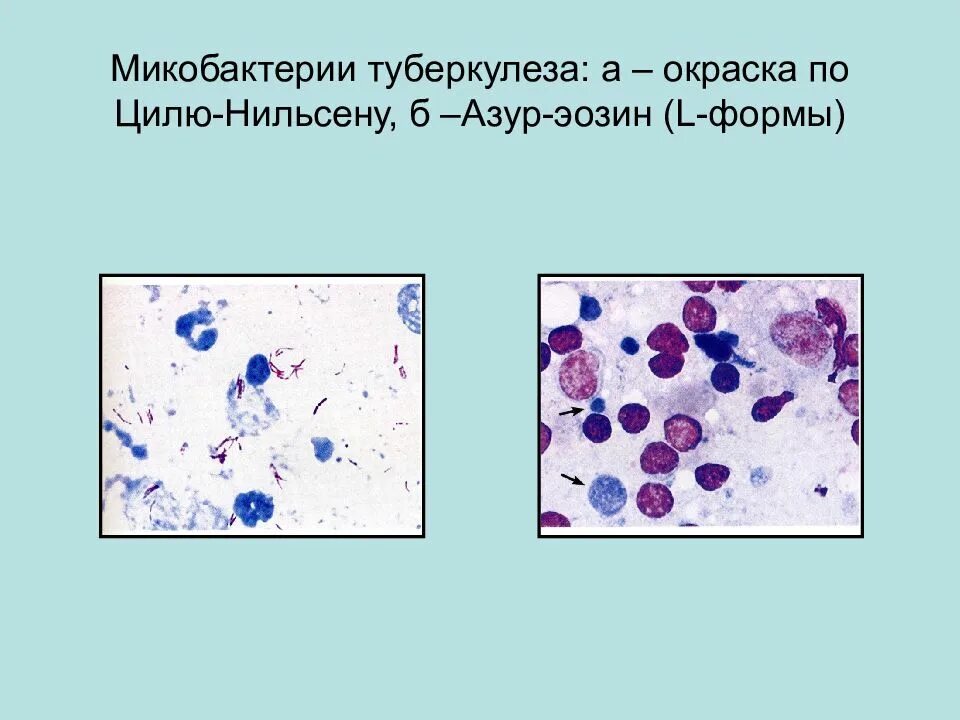 Туберкулез окраска по Цилю-Нильсену. Mycobacterium tuberculosis), окрашенный по Цилю-Нильсену. Мазок по Цилю-Нильсену туберкулез. Микобактерии туберкулеза Циль Нильсен.