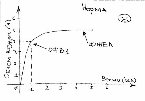 Спирограмма пример. Спирограмма при бронхиальной астме. спирограмма при бронхиальной астме показатели. спирография при бронхиальной астме заключение. спирометрия заключение норма.