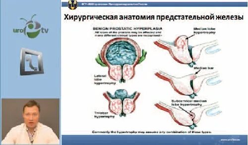 Хирургическая анатомия простаты. Хирургическая капсула простаты. Хирургическая и анатомическая капсула предстательной железы. Хирургическая капсула предстательной железы это. Почему после удаления простаты