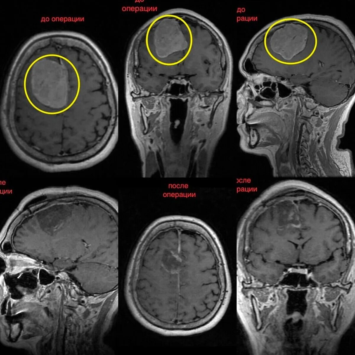 Опухольголлвного мозга. Опухоли головноготмозга. Объемное образование головного мозга. Опухоль головного мозга отек