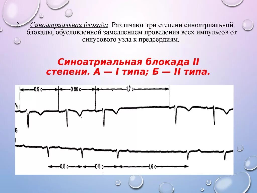 Са блокада типы. Синоатриальная блокада Мобитц 1. Блокада синусового узла 2 степени. Са блокада 2 степени 2 типа на ЭКГ. Синоатриальная блокада без периодов Самойлова Венкебаха.