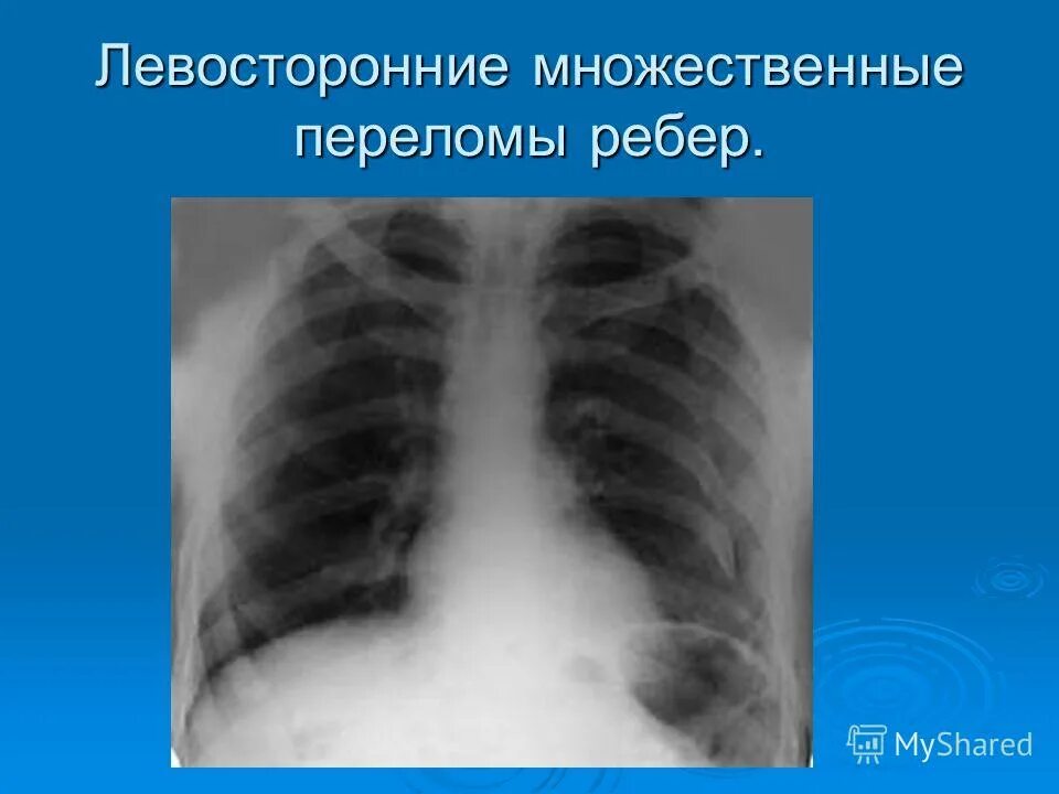 Повреждение легкого ребрами. Пневмоторакс при переломе ребер рентген. Перелом ребер с пневмотораксом рентген. Консолидированный перелом ребра на рентгене. Перелом грудной клетки рентген.