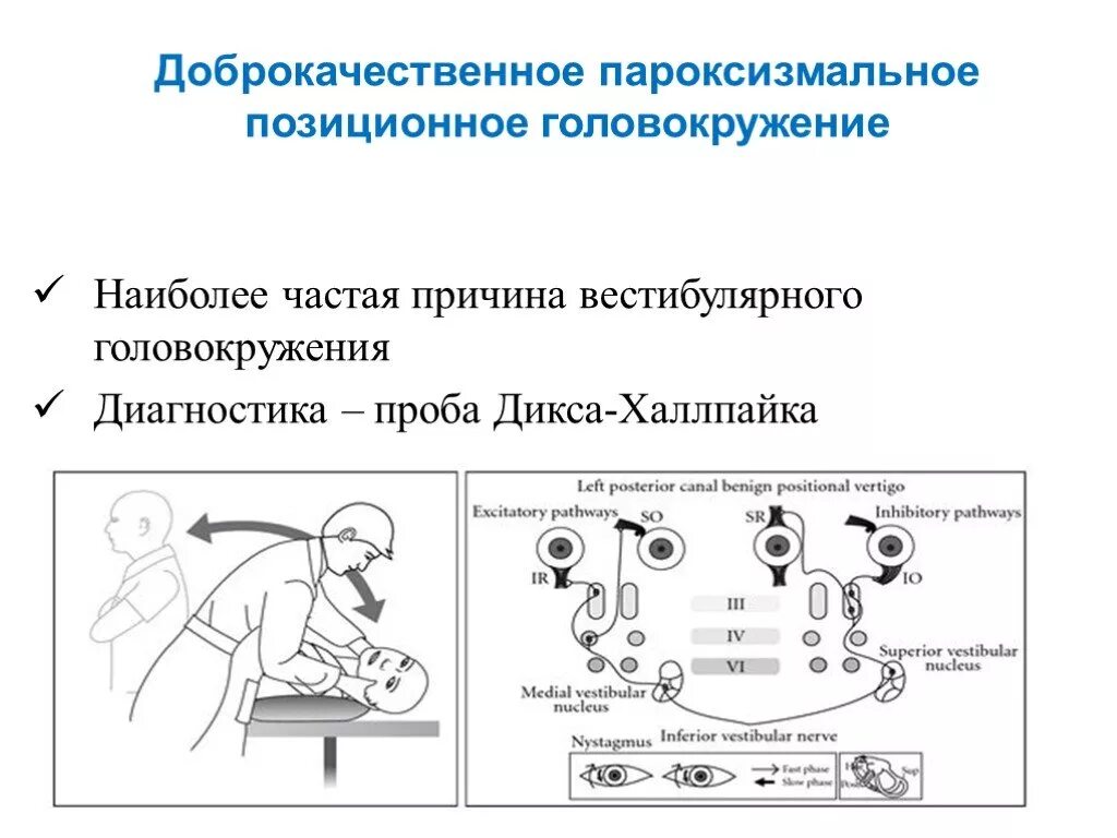 ДППГ доброкачественное пароксизмальное позиционное. Доброкачественное головокружение позиционного диагноз. ДППГ формулировка диагноза. Доброкачественное позиционное пароксизмальное головокружение пробы.