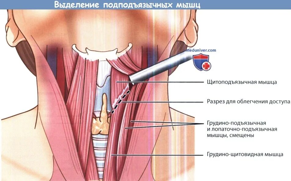 Мышца поднимающая щитовидную железу. Мышцы щитовидной железы. Мыщшы щитовидной железы. Резекция щитовидной железы. Удаление правой доли щитовидной