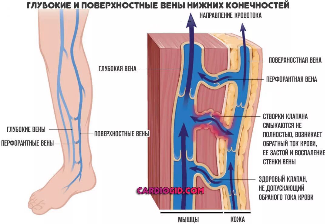 Острый тромбофлебит поверхностных,глубоких вен нижних конечностей. Мазайшвили ультразвуковая анатомия вен нижних конечностей. Перфорантные вены нижних конечностей анатомия. Флеботромбоз глубоких вен нижних конечностей. Тромбоз артерия и вена