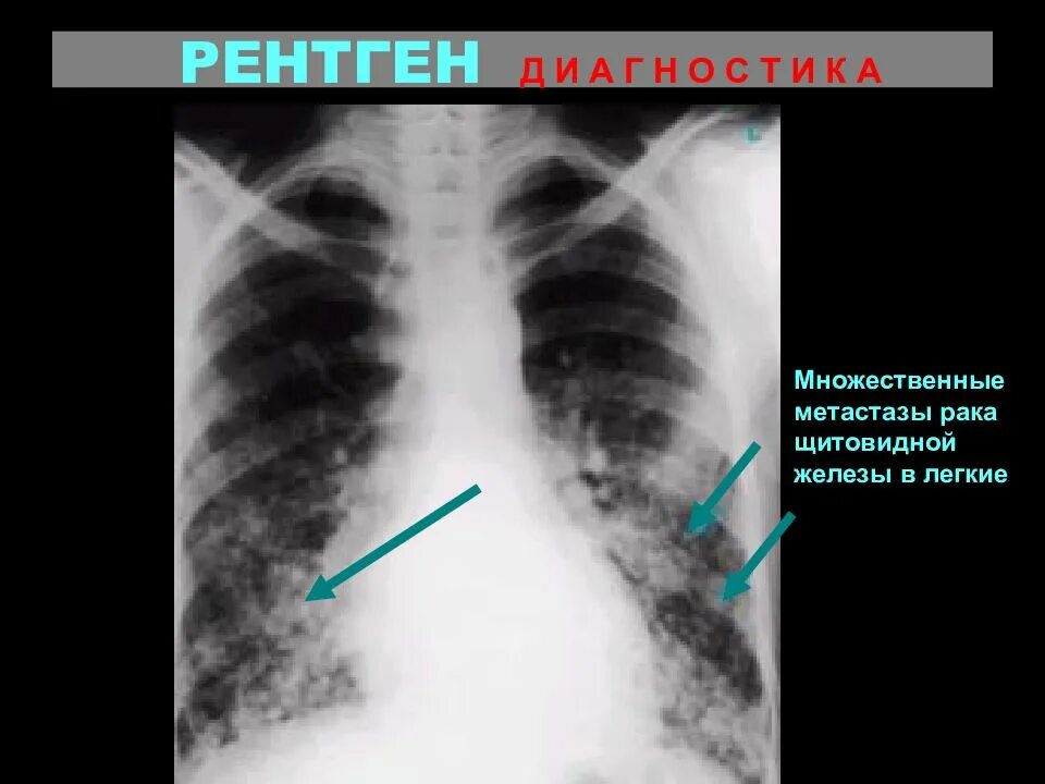 Рак молочной железы метастазы в легких