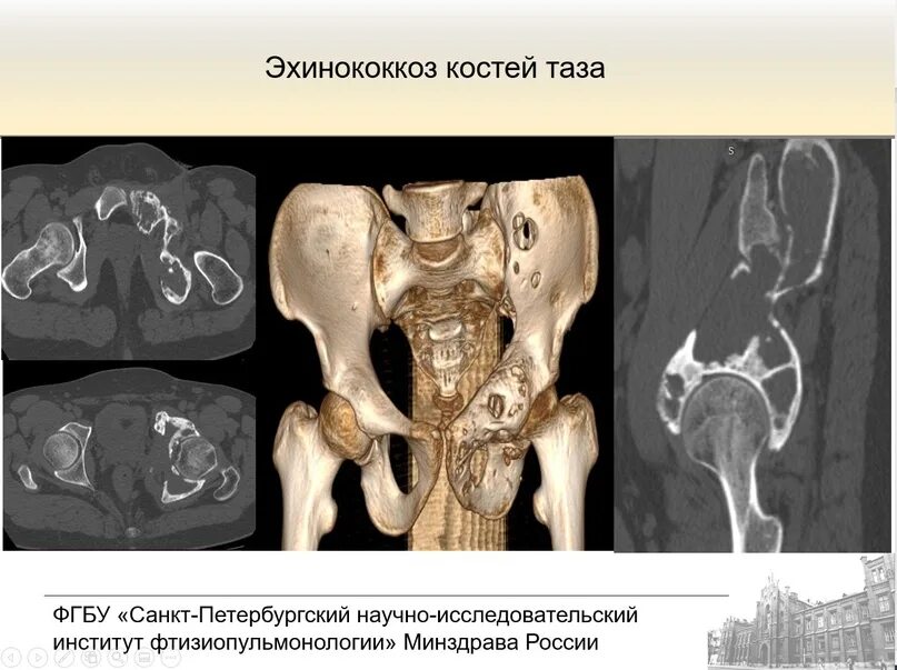 Кт подвздошной кости. Остеосклеротический очаг в подвздошной кости на кт. Остеобластические метастазы в кости таза на кт.