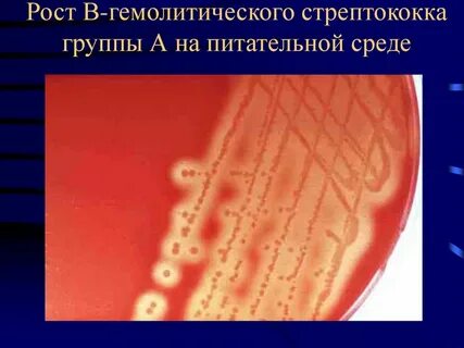 Бета гемолитический стрептококк группы b
