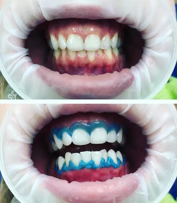 Отбеливание амазинг Вайт. Эмейзинг отбеливание зубов. Отбеливание зубов amazing White. Отбеливание amazing White до после.