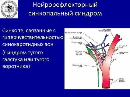 Каротидный синус