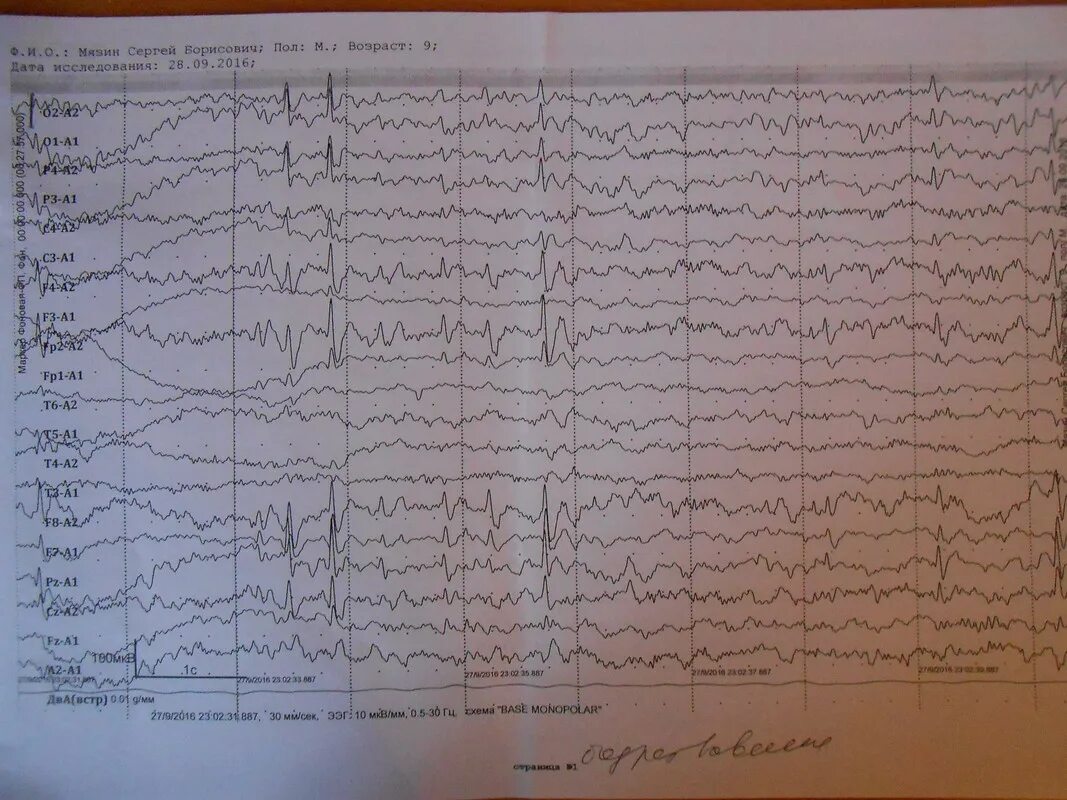 Ээг отзывы детям. Энцефалограмма головного мозга норма эпилепсия. ЭЭГ паттерн фокального эпилептического приступа. ЭЭГ норма и ЭЭГ эпилепсия. Эпилепсия у детей ЭЭГ ночное.
