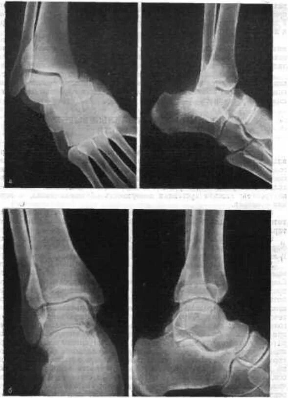 Перелом голеностопного сустава. Подтаранный вывих рентген. Подтаранный вывих стопы рентген. Вывих ладьевидной кости стопы рентген. Подвывих таранной кости рентген.