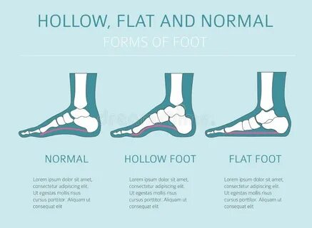 Flat footed