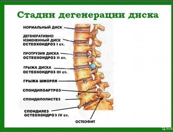 Заболевания позвоночника. Остеохондроз. Остеохондроз спины. Остеохондроз межпозвонковых дисков.