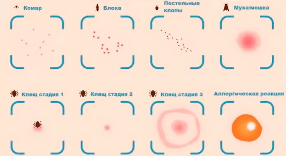 Признаки микро. Место укуса клеща как выглядит у ребенка. Форма укуса клеща на коже. Прыщи на коже после укуса клеща. Укусы от клопов как отличить.