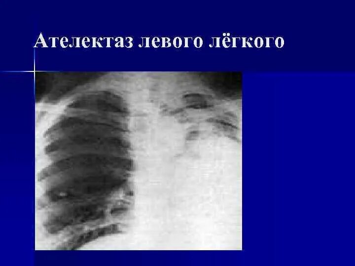 Ателектаз левой доли легкого. Ателектаз на рентгене. Ателектаз правого легкого рентген. S4 s5 ателектаз. Ателектаз s3 левого легкого.