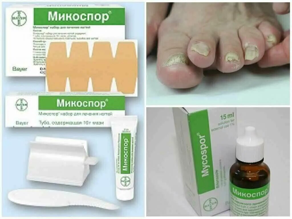 Набор для лечения ногтей. Микоспор для грибок ногтей. Микоспор мазь от грибка. Капли от грибка ногтей на ногах. Микоспор от грибка ногтей на ногах.