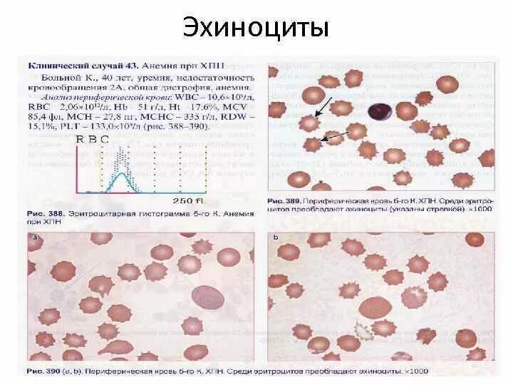 Формы эритроцитов эхиноциты. Эхиноциты анемия. Эхиноциты эритроциты. Эхиноцит причины.