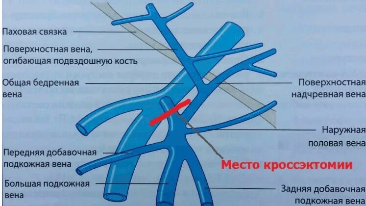 Операция троянова-тренделенбурга. Кросэктомия. Операция троянова-тренделенбурга показания. Операция троянова-тренделенбурга техника. Кроссэктомия операция троянова тренделенбурга.