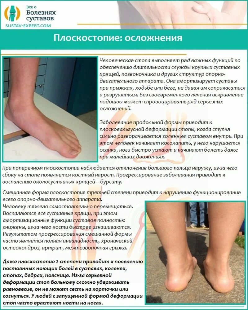 При ходьбе болят ступни что это