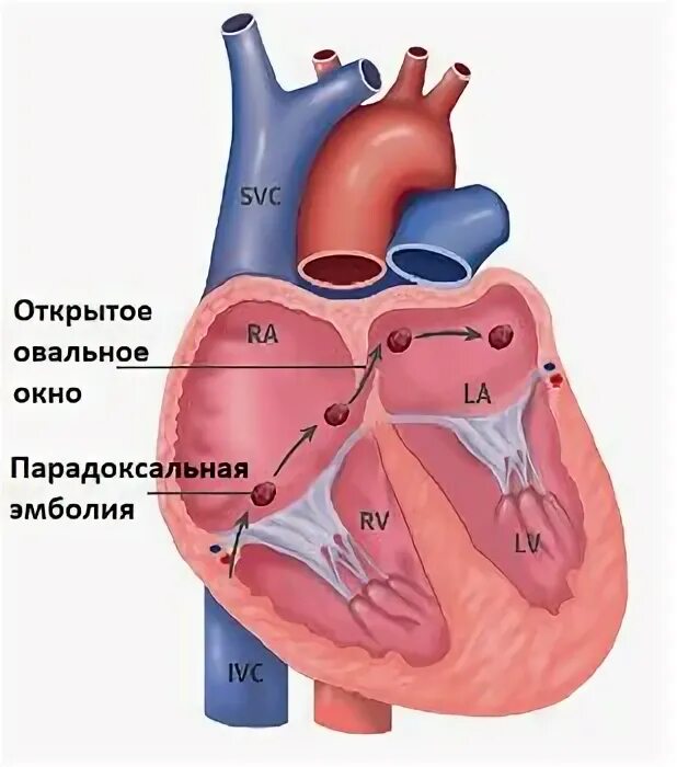 Овальный клапан. Незакрытые овальное окно 3. Открытое овальное окно межпредсердной перегородки. Открытое овальное окно в сердце. Овальный клапан.