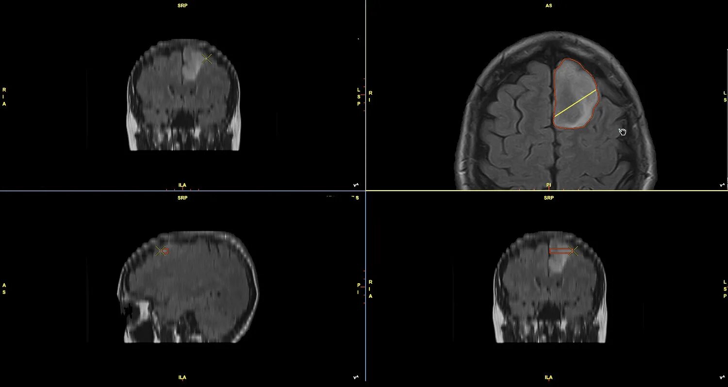 Метастазы в мозгу форум. Волюметрия мозга. Глиома Grade 1 кт. Диффузная срединная глиома с мутацией. Кт Волюметрия.