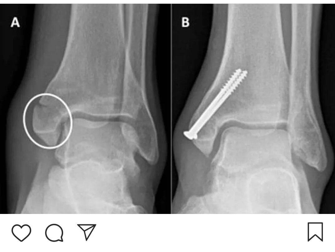 Супинационный перелом лодыжки. Супинационный перелом лодыжки рентген. Перелом лодыжки с остеосинтезом. Чрезсиндесмозный перелом малоберцовой кости. Не заметил перелом