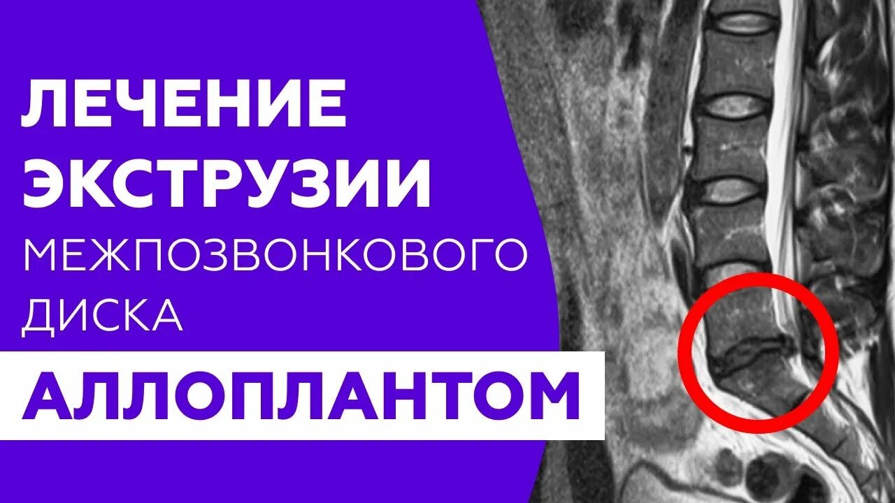 Аллоплант для суставов цена отзывы пациентов. Аллоплант позвоночник. Экструзия диска позвоночника. Экструзия дисков позвоночника лечение. Аллоплант для суставов.