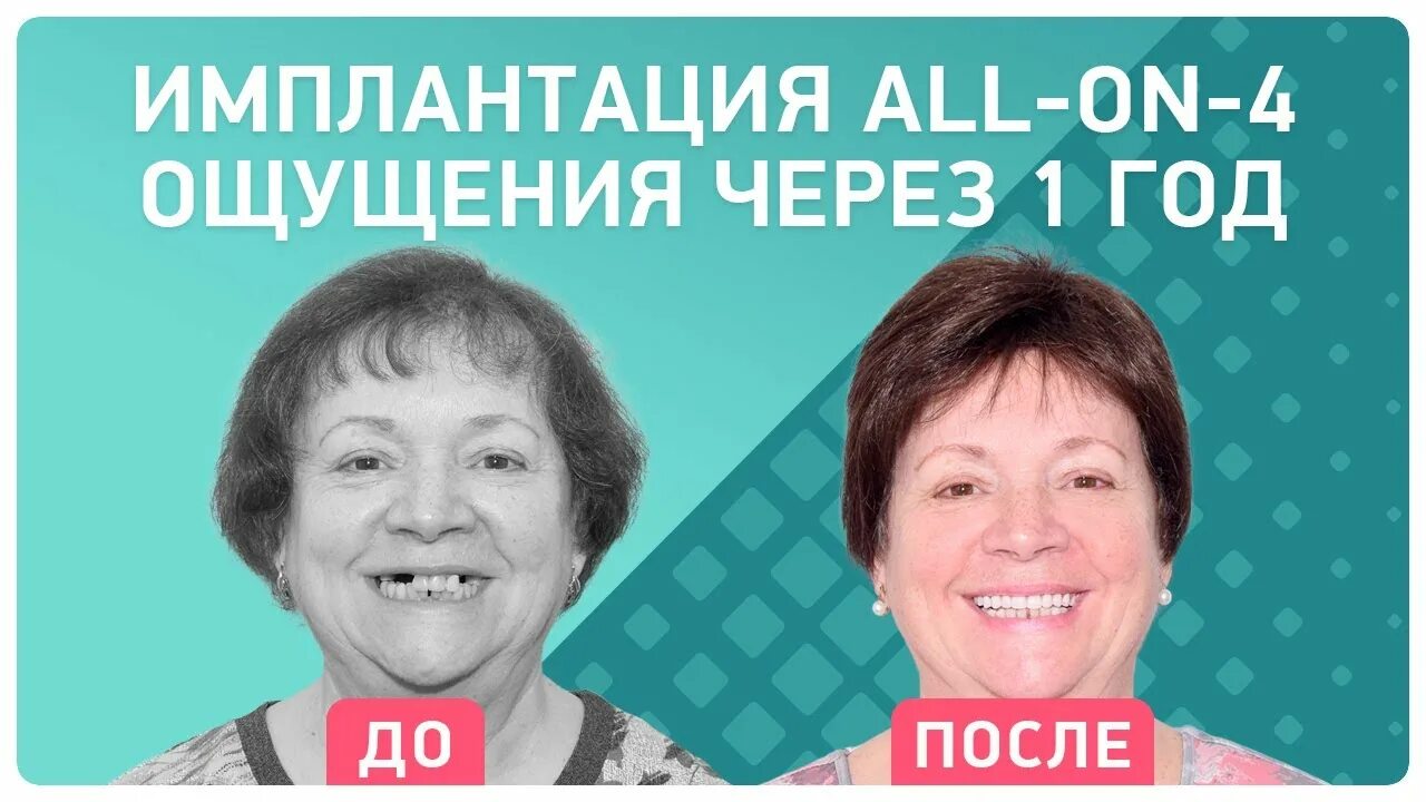 Несъемное протезирование all-on-4. Мост на имплантах на 4 зуба. Зубы на имплантах отзывы реальных пациентов. Зубы на имплантах отзывы реальных пациентов. Зубы на имплантах отзывы реальных пациентов.