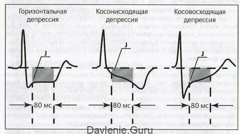Депрессия сегмента st что это значит