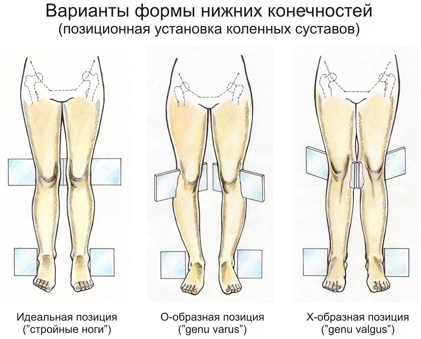 Как исправить деформацию