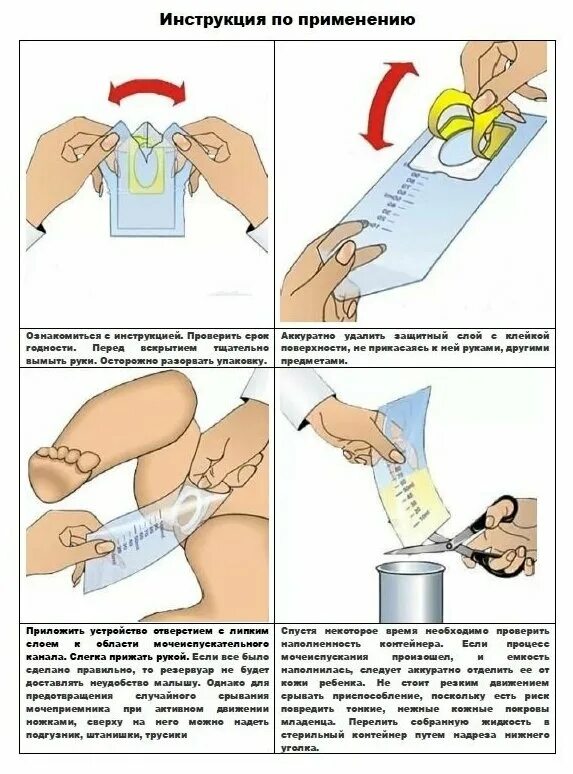 Как правильно одеть мочеприемник девочке. Как правильно одеть мочеприемник девочке