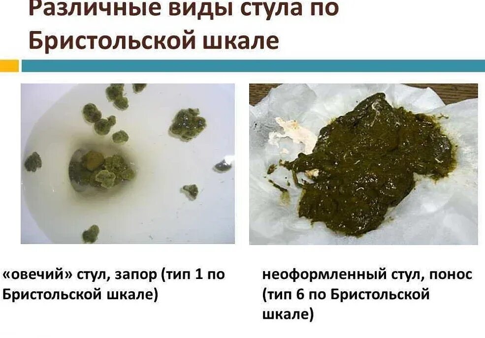 Какой бывает понос. Черный цвет кала при кровотечении. Дегтеобразный стул мелена. Черный и дегтеобразный цвет кала. Кал при кровотечения в желудочно-кишечном.