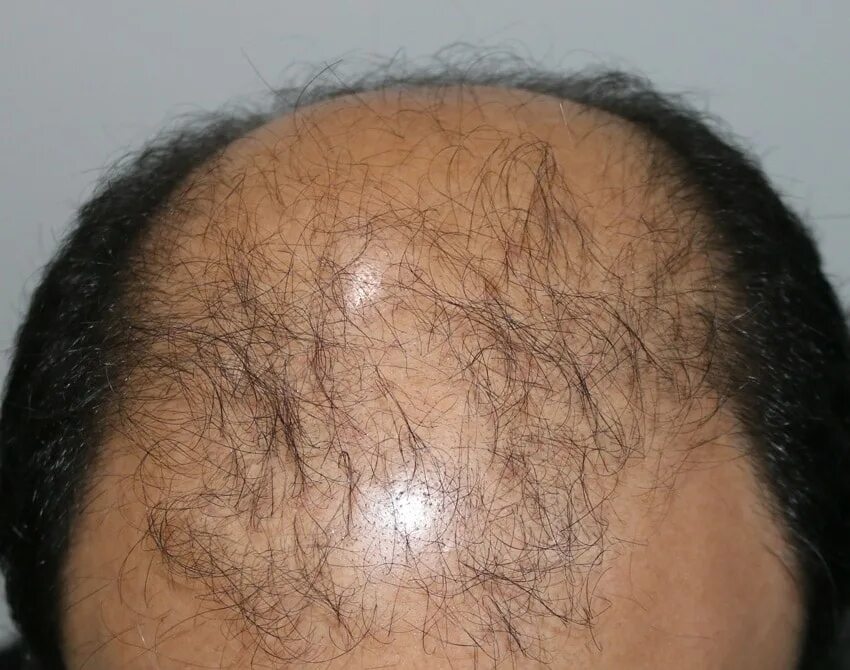 Генетическое выпадение волос. Лысая голова. Андрогензависимая алопеция мужчин. Сонник облысение. Выпадение волос.