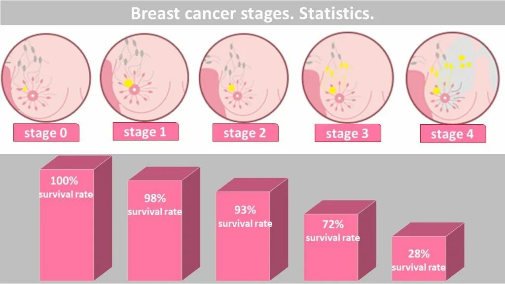 Сколько по времени развивается рак. Опухоль молочной железы стадии. Размер опухоли молочной железы по стадиям. Карцинома молочной железы 1 стадия. Стадии развития опухоли молочной железы.