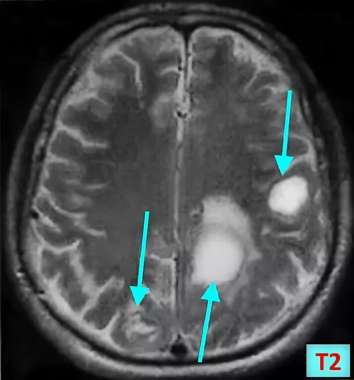 Метастазы в мозг прогноз. Метастаз в головном мозге кт мрт. Метастазы головного мозга кт. Метастазы меланомы в головной мозг кт.