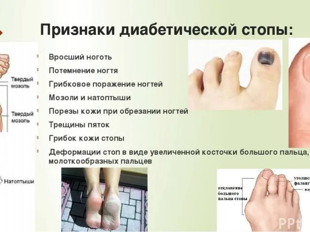 диабет 2 типа ноги