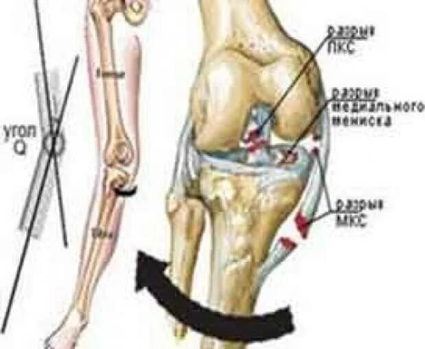 Задняя крестообразная связка коленного сустава анатомия. Разрыв крестообразной связки коленного сустава. Разрыв задней крестообразной связки рентген. Аутопластика ПКС коленного сустава. Травма коленного сустава код