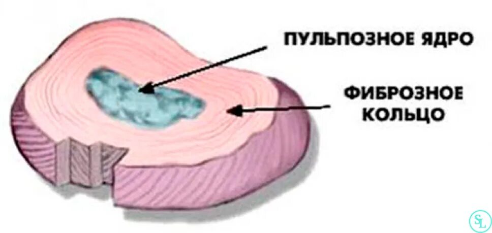 Содержимое межпозвоночного диска. Пульпозное ядро и фиброзное кольцо. Пульпозное ядро межпозвоночного диска гистология. Фиброзное кольцо межпозвоночного диска. Фиброзное кольцо межпозвонкового диска.