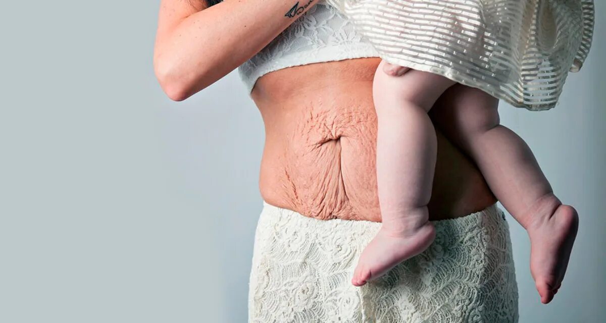 Живот женщин после рождения ребенка. Живот после беременности по неделям. Дряблый живот после родов. Живот женщины после родов. Живот сразу после родов.