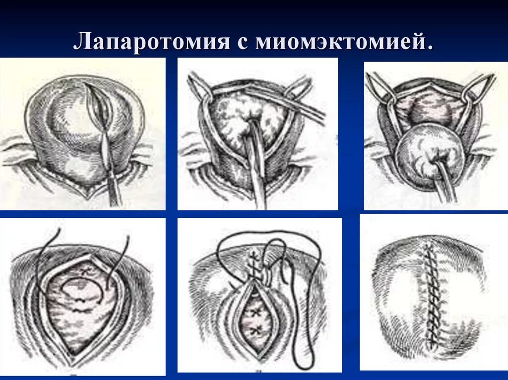 Удаление стенки матки