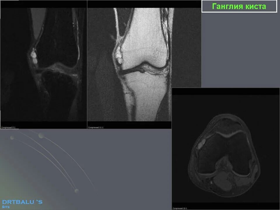Параменисковая киста коленного сустава мрт. Ганглий коленного сустава мрт. Ганглиевая киста коленного сустава мрт.