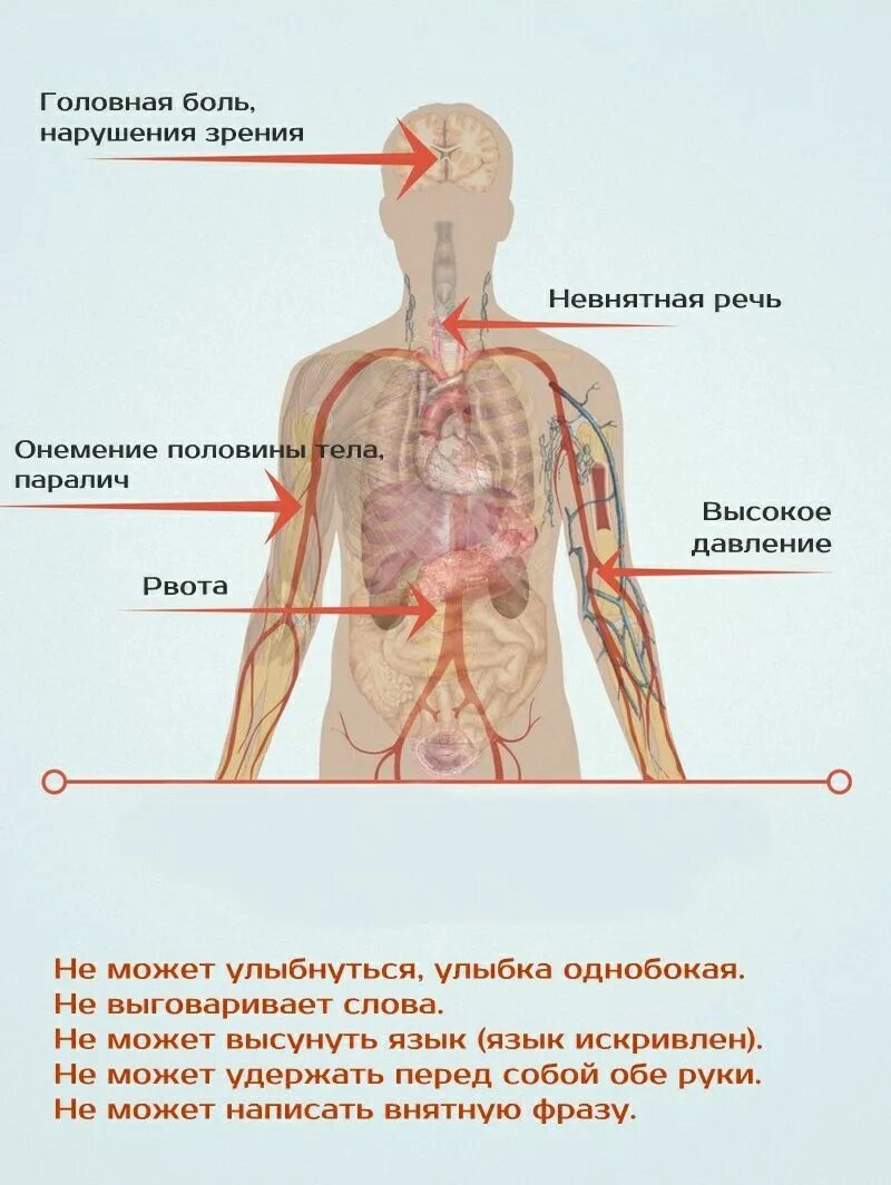 Инфаркт симптомы и последствия. Инсульт симптомы. Признаки инсульта. Инфаркт симптомы. Инфаркт миокарда симптомы.